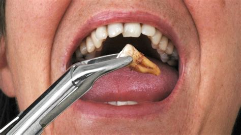 cid extração de dente